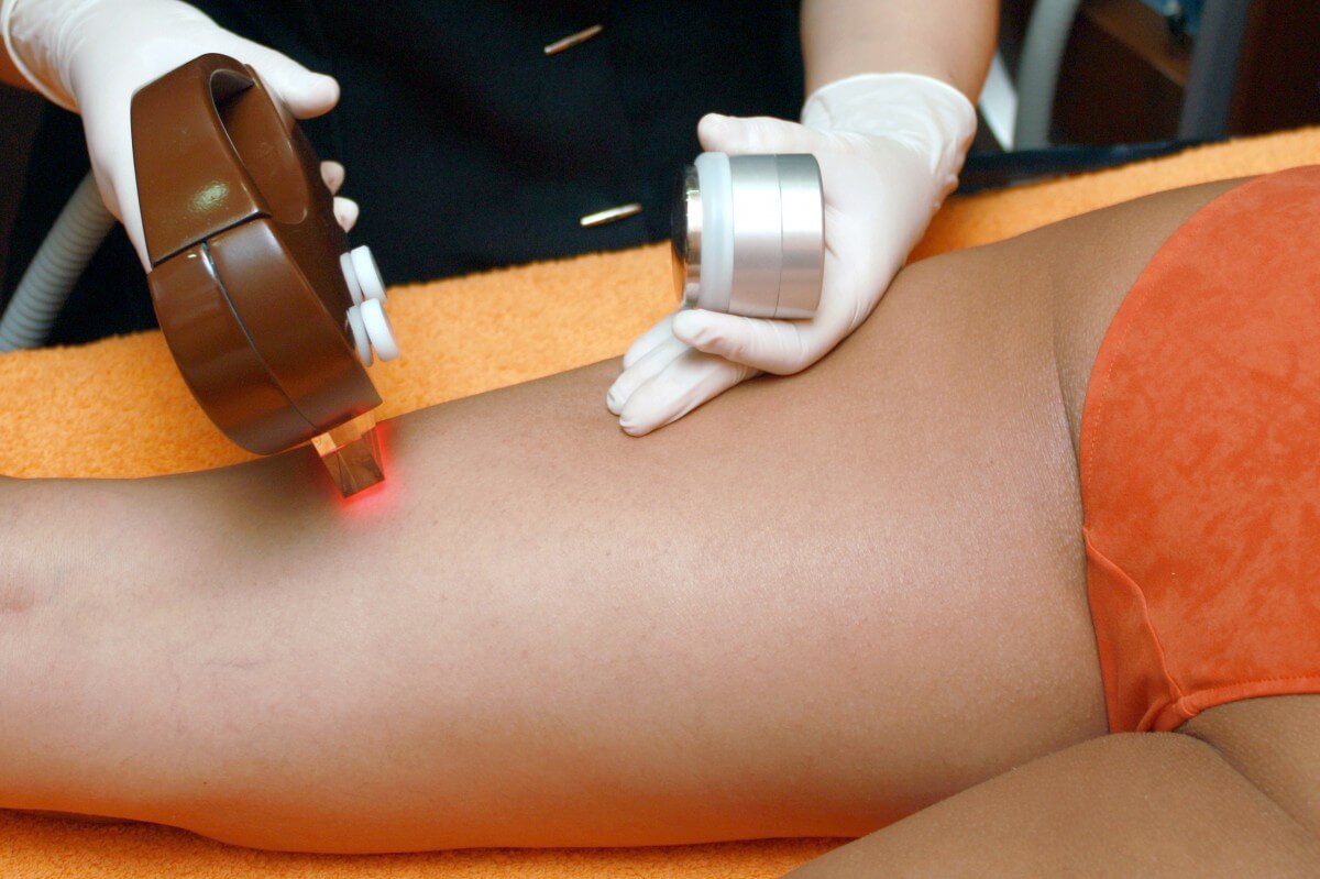 laser hair removal bad experiences